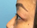 Lower Eyelid Blepharoplasty