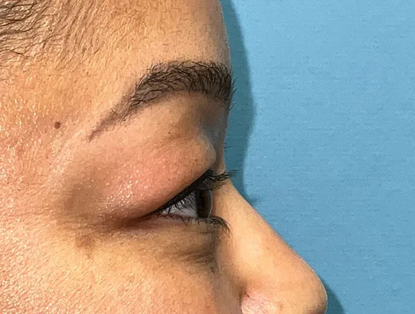 Lower Eyelid Blepharoplasty