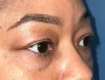 Lower Eyelid Blepharoplasty